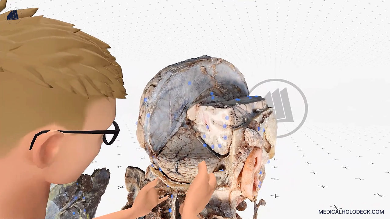 Brain aneurysms - the silent threat thumbnail 4